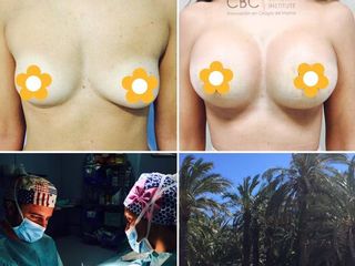 Antes y después Mastopexia con implantes