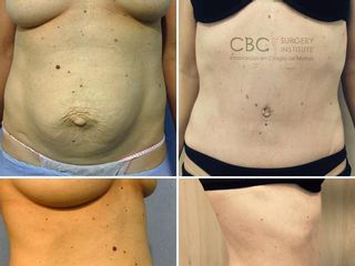 Antes y después Abdominoplastia
