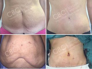 Antes y después Abdominoplastia