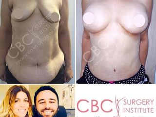 Antes y después Abdominoplastia y reconstrucción mamaria 