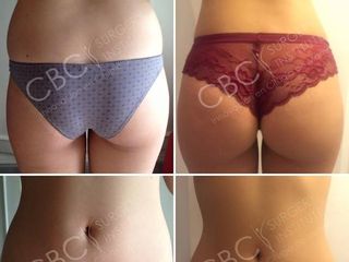 Antes y después Lipoescultura -Transferencia de grasa a glúteos