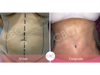 Antes y después abdominoplastia