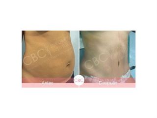 Antes y después abdominoplastia