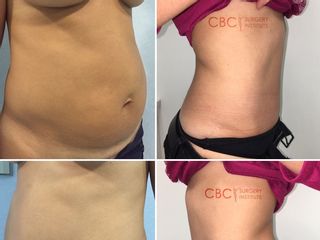 Antes y después Abdominoplastia y lipoescultura