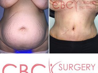 Antes y después abdominoplastia