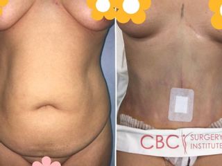 Antes y depués abdominoplastia