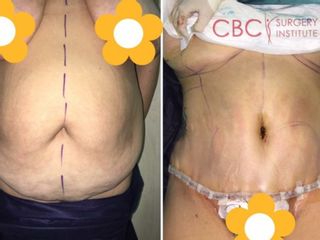 Antes y depués abdominoplastia