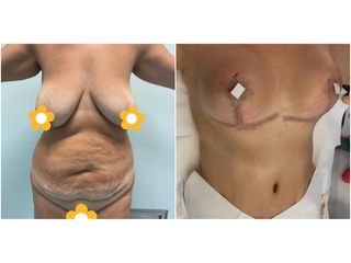 Lipoescultura - CBC Surgery Institute
