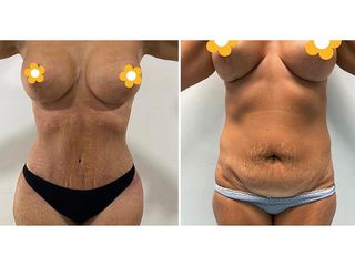 Lipoescultura - CBC Surgery Institute