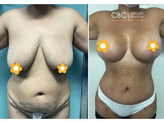 Lipoescultura - CBC Surgery Institute