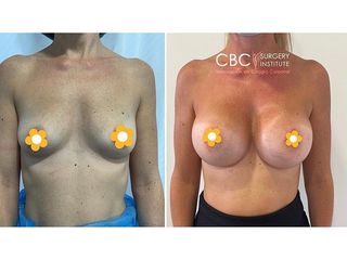 Aumento de pecho - CBC Surgery Institute
