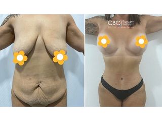 Lipoescultura - CBC Surgery Institute