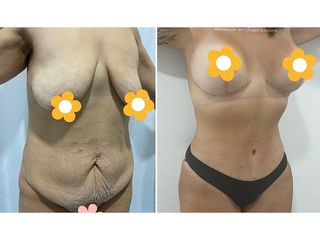 Lipoescultura - CBC Surgery Institute