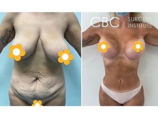 Lipoescultura - CBC Surgery Institute