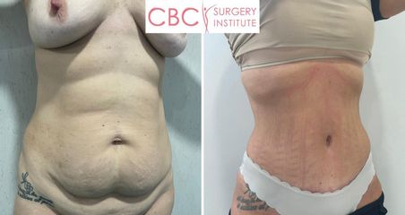 Abdominoplastia - CBC Surgery Institute