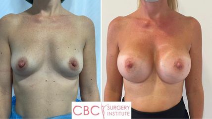 Aumento de pecho - CBC Surgery Institute