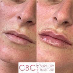 Aumento de labios - CBC Surgery Institute