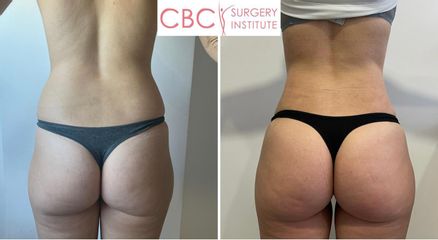 Aumento de glúteos - CBC Surgery Institute