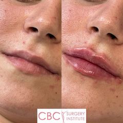 Aumento de labios - CBC Surgery Institute