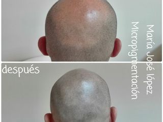 Antes y después micropigmentación capilar, efecto rapado