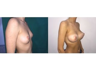 Antes y después Aumento de pecho