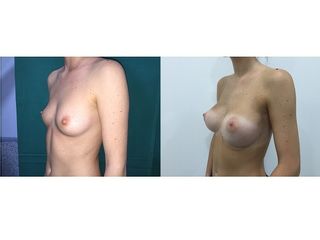 Antes y después Aumento de pecho
