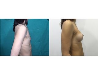 Antes y después Aumento de pecho