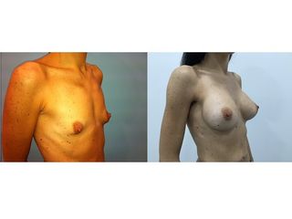 Antes y después Aumento de pecho