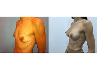 Antes y después Aumento de pecho