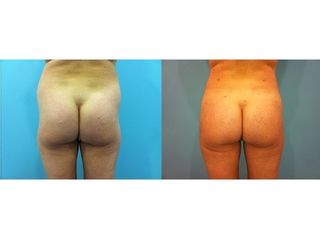 Antes y después Aumento de glúteos