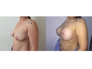 Antes y después Aumento de pecho