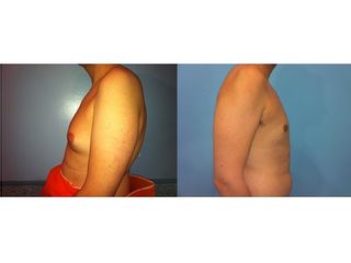 Antes y después Ginecomastia