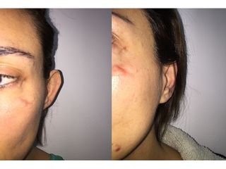 Antes y después tratamiento anti cicatrices 