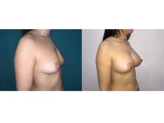 Antes y después Aumento de pecho