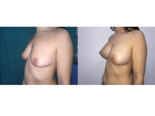 Antes y después Aumento de pecho