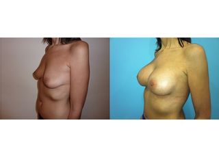 Antes y después Aumento de pecho