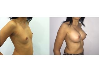Antes y después Aumento de pecho