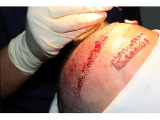 Cirugía capilar o injerto capilar en Málaga