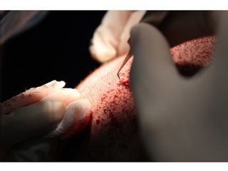 Injerto de pelo o trasplante capilar técnica FUE