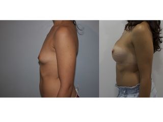 Antes y después Aumento de pecho