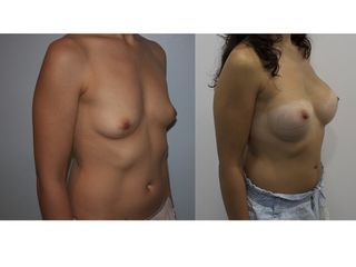 Antes y después Aumento de pecho