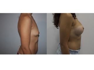Antes y después Aumento de pecho