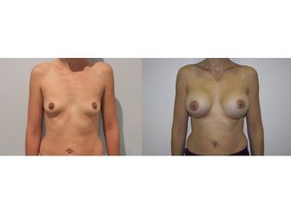 Antes y después Aumento de pecho