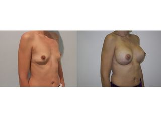 Antes y después Aumento de pecho
