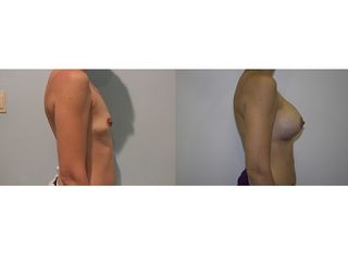 Antes y después Aumento de pecho