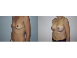 Antes y después Aumento de pecho