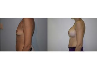 Antes y después Aumento de pecho