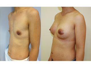 Antes y después Aumento de pecho
