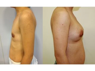 Antes y después Aumento de pecho