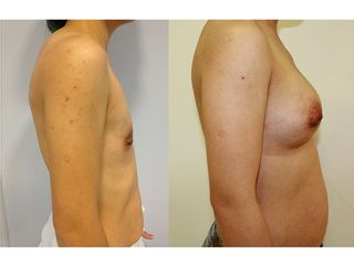 Antes y después Aumento de pecho